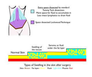 How to control post operative swelling after tummy tuck