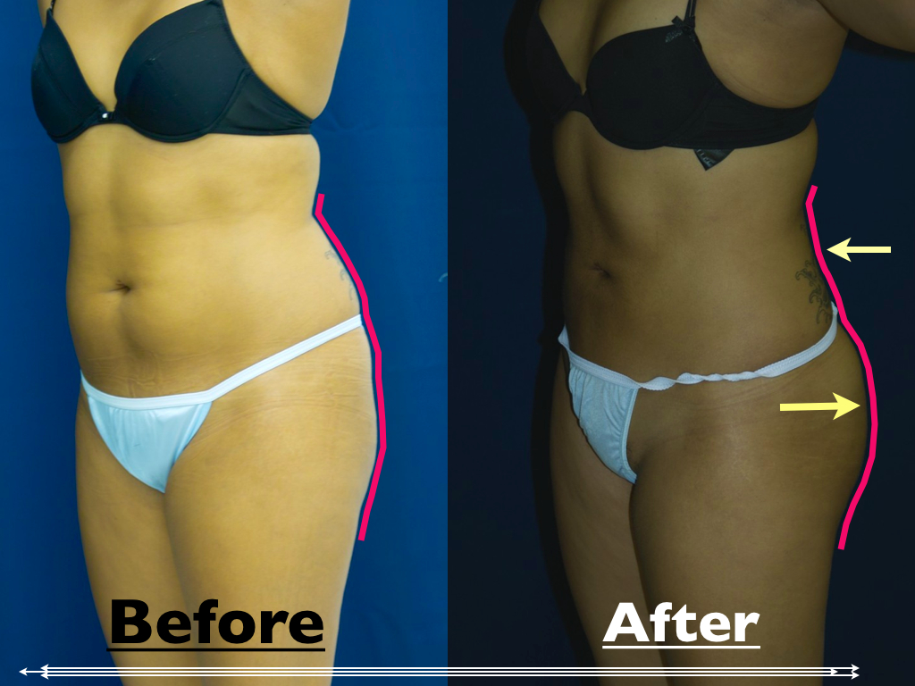 bmore-buttlift3-40011 bmore-buttlift3-40011