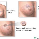 Lumptectomy