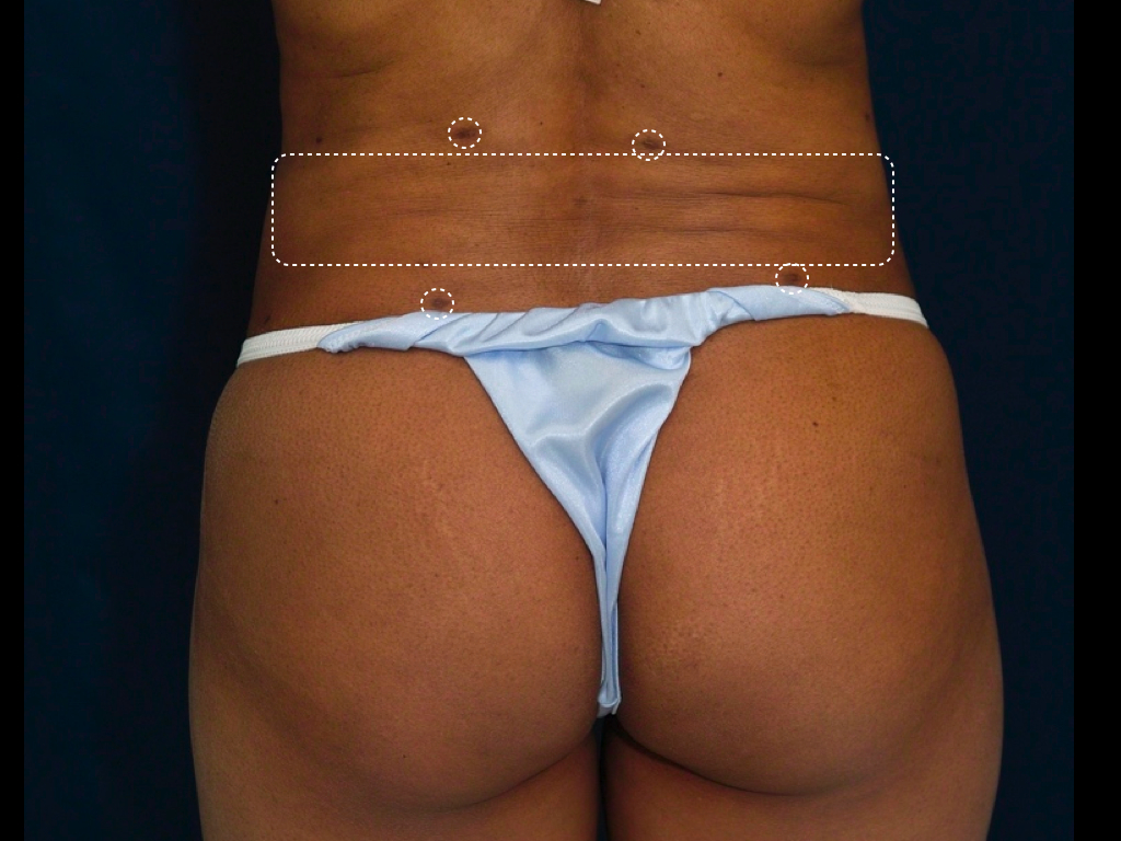 Back Lipo
