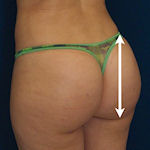 side view after brazilian butt lift