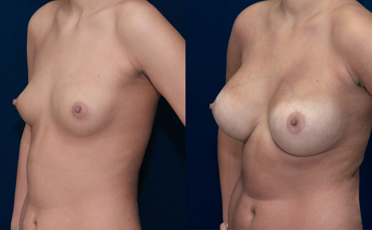 550Cc High Profile Silicone Breast Implants Pictures