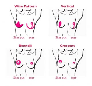 An illustration showing a breast scar comparison for various techniques.