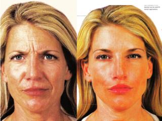 A collage of photos of a patient before & after a Liquid facelift.
