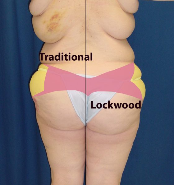 A photo of a patient's body, showing her body before and after a body lift procedure.