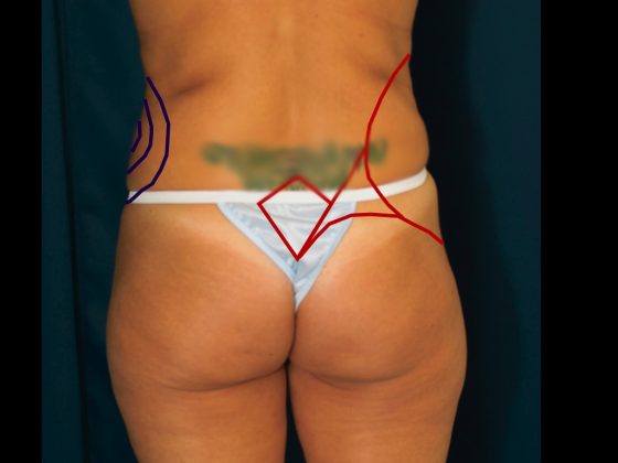 An illustration showing preoperative markings for a lipo to love handles procedure.