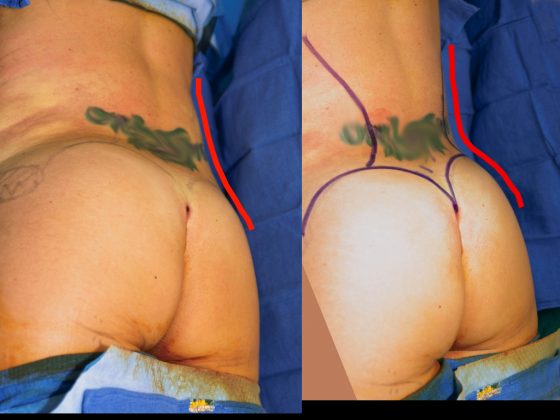 An illustration showing preoperative markings for a lipo to love handles procedure.