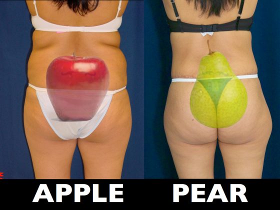A collage of patients photos illustrating apple and pear shaped bodies.