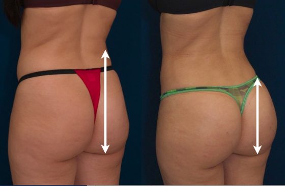 A collage of photos (side view) of a patient before and after a Brazilian butt lift procedure.