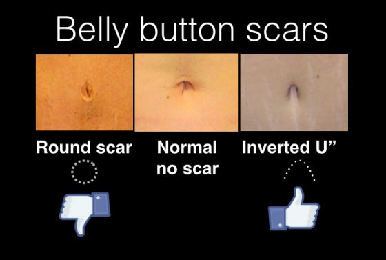 A collage of 3 photos showing different types of belly button scars.