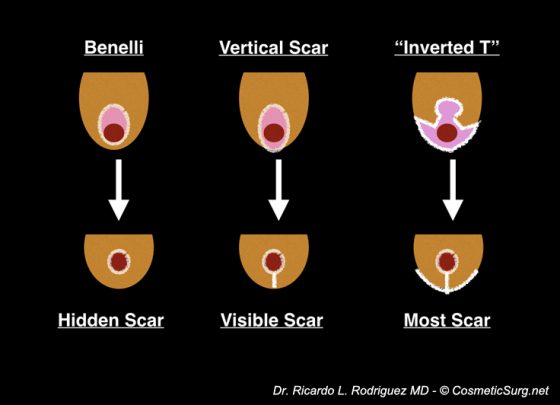 A diagram showing breast lift surgical techniques and scars.