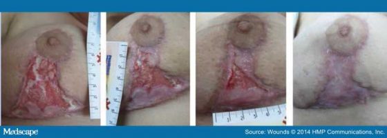 A collages of photos showing a breast scar complication.