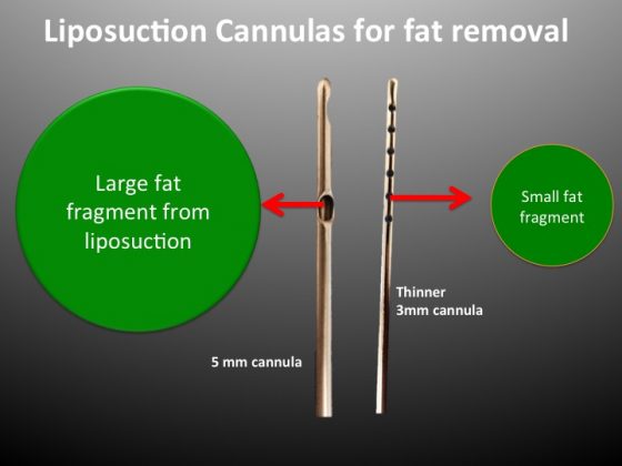 An illustration showing why thin cannulas with 1mm holes are best for fat grafting.