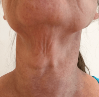 Photo of bands in the neck that can be addressed with a Platysmaplasty or Neck tuck.