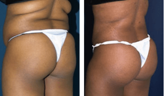 A collage of photos of a patient's lower body, showing her before and after a Brazilian butt lift procedure.