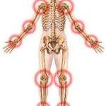 An illustration of the human body pointing out points of Arthritis.