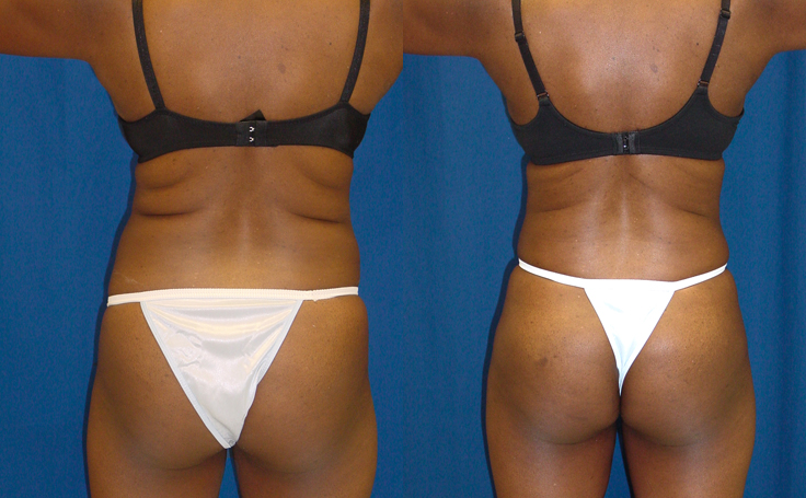 Before and after photo of an actual Tummy Tuck patient.