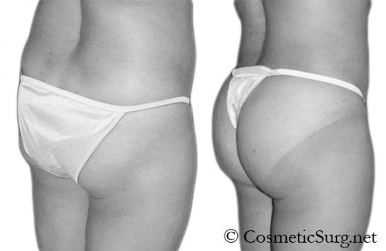 A patient Before & after a Brazilian butt lift with fat injections.