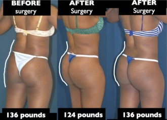 A collage of photos of a case study into Brazilian butt lift after weight change case study photo.