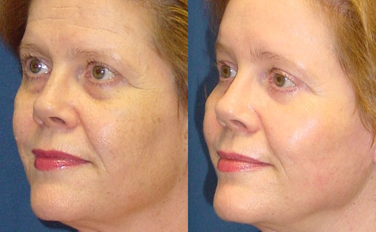 Before and after photo of an actual Brow Lift patient.
