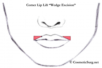 Corner lip lift illustration showing the wedge excision.