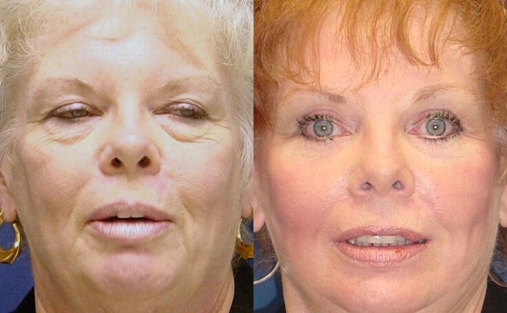 Before and after photo of an actual Eyelid Surgery patient.