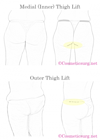 Inner and outer thigh lift incision and scar locations diagram.