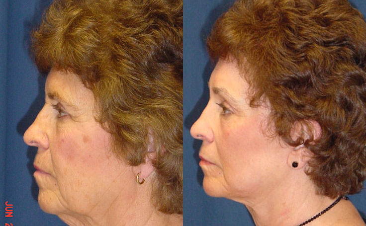 Before and after photo of an actual Laser Skin Resurfacing patient.