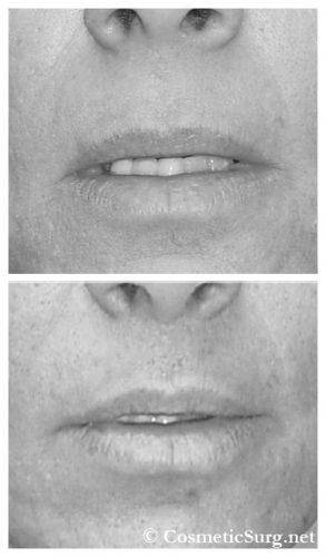 Before & after photo of a Lip lift surgery.