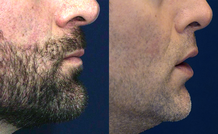 Before and after photo of an actual Lip Lift patient.