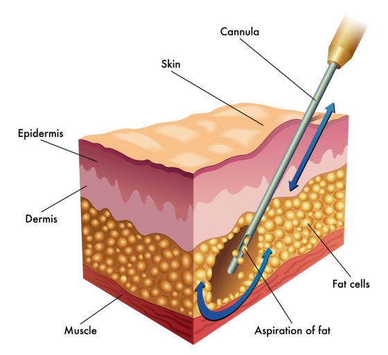 diagram of liposuction using a cannula with a larger hole at the tip