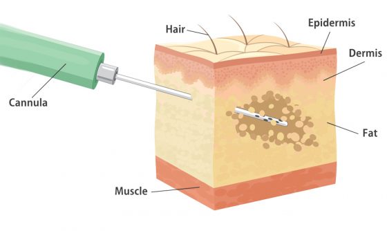 liposuction diagram using small diameter cannula with small holes