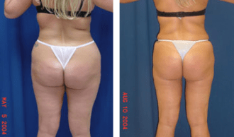 A collage of photos of a patient before and after a Liposuction.