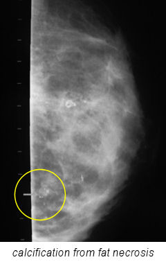 X-ray: Calcification from fat necrosis.