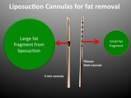 An illustration showing the types of cannulas used for Liposuction.