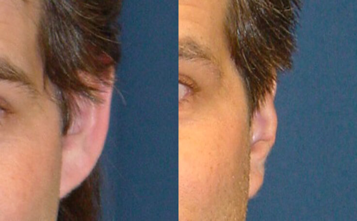 Before and after photo of an actual Otoplasty patient.