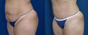 A collage of photos showing a patient before and after a Tummy tuck procedure.