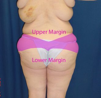 Body Lift skin excision location