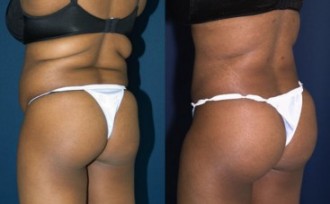 A collage of photos of a patient before and after a Brazilian butt lift procedure.