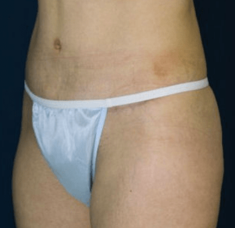 A panty line scar after a Tummy tuck procedure.