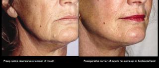 cornerofmouthliftrodriguez DAO release: Before and After (courtesy Dr. Le Louarn, Aesthetic Surgery Journal Vol 26, No 5)