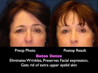 botoxdetoxbrowlift Botox Detox: The Browlift procedure