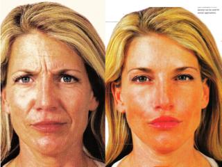 liquid_facelift1 Before and After Liquid Facelift (courtesy Allergan)
