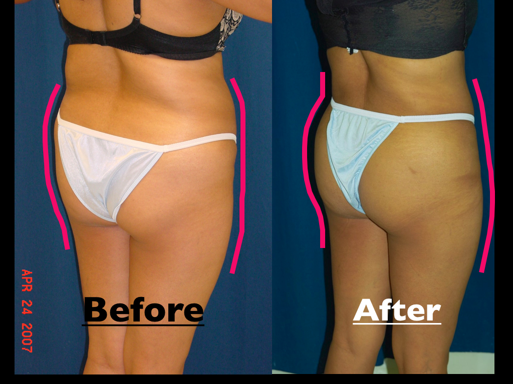 Click to enlarge B'more Butt Lift by Dr. Ricardo Rodriguez