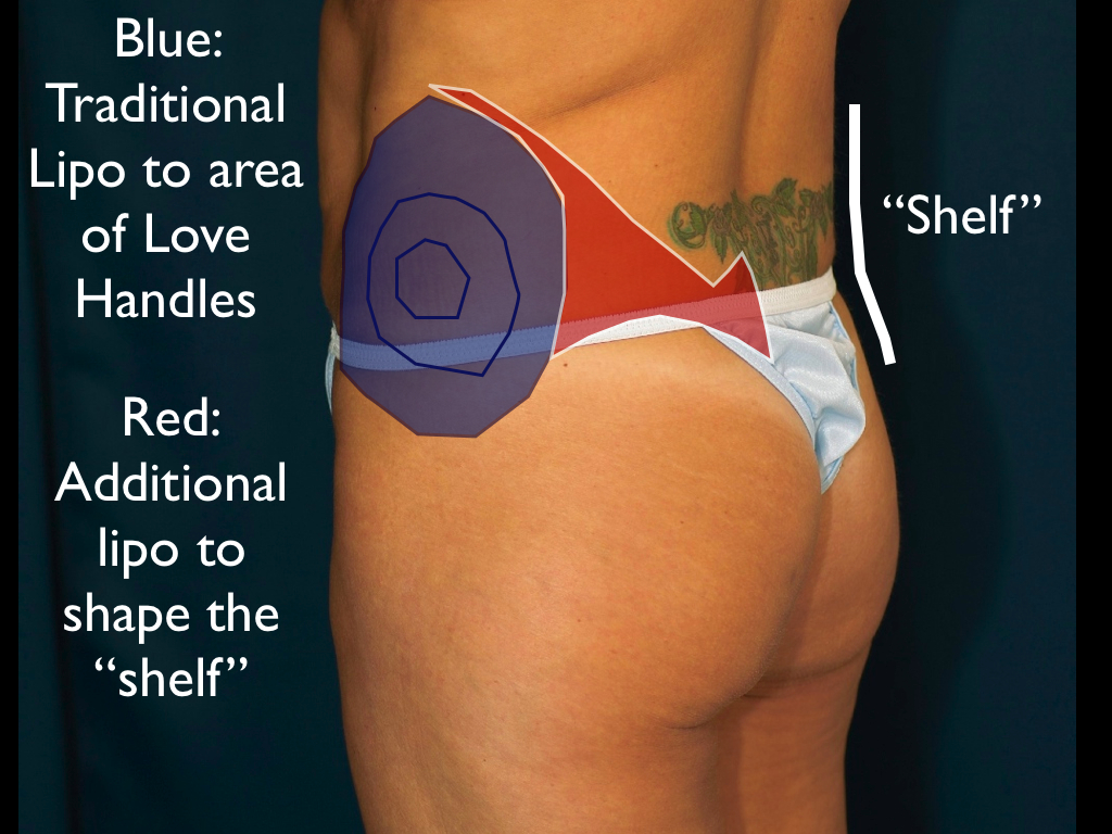 lipo-to-handles-better-technique0021 Extended area of lipo improves the "shelf", or transition area between lower back and buttock