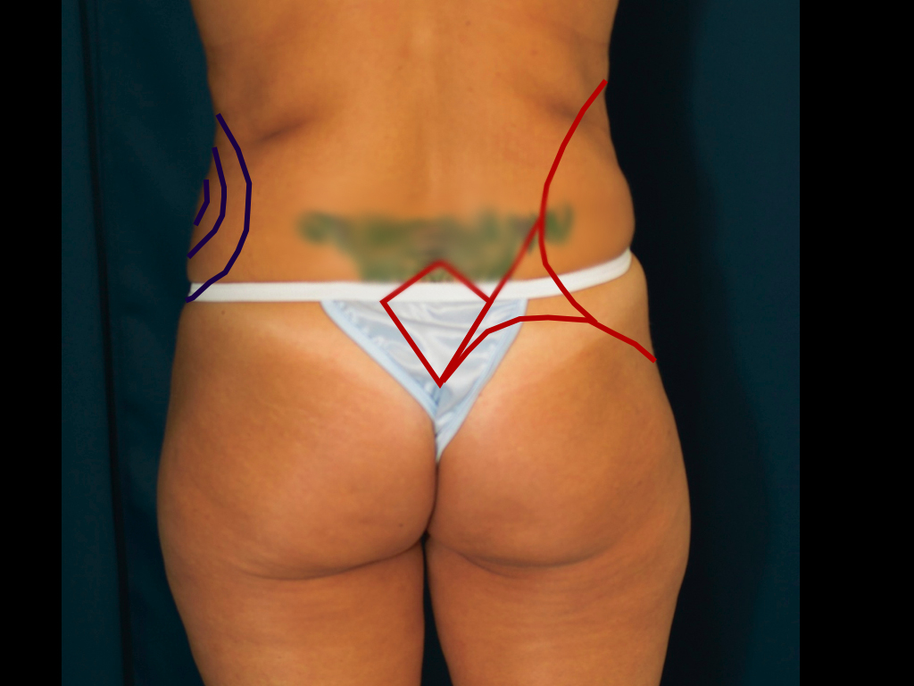 lipo-to-love-handles-markings2 Blue- markings for lipo to love handles. Red- markings for reshaping waist