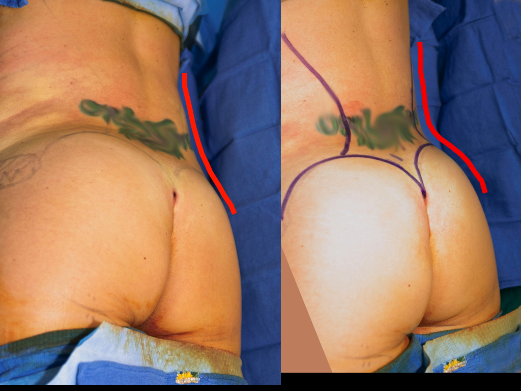 lipo-to-love-handles-shelf0033 Red line follows waist contour before (left) and after (right) lipo