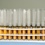 stemcellsinfatcellsrodriguez Your own fat contains adult stem cells