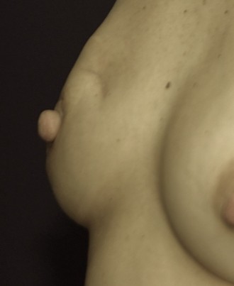 lumpectomy before fat Lumpectomy and Radiation performed
