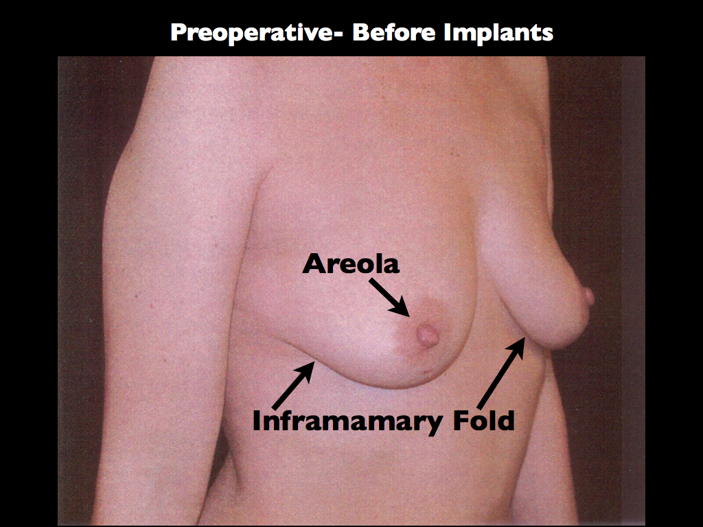 preopbreastaugwithlift
